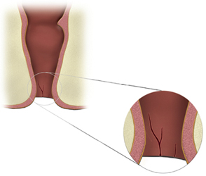 Rift endetarmen (fissur) |